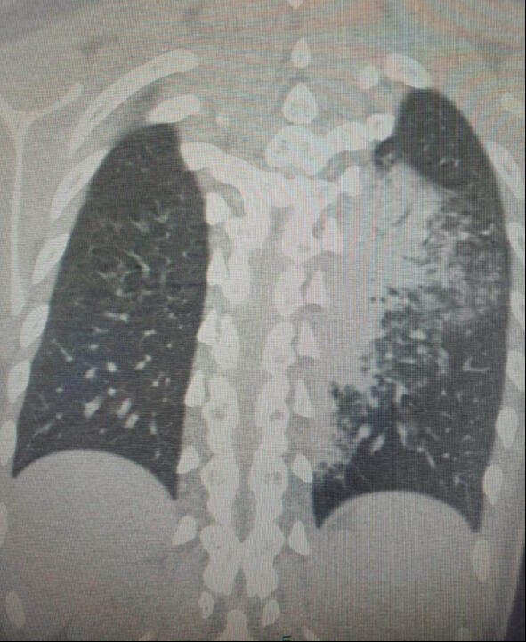 Türkiye'de alarm veren yeni salgın çocuklarda daha fazla ölümcül oluyor Türkiye'de alarm veren yeni salgın çocuklarda daha fazla ölümcül oluyor - 2. Resim