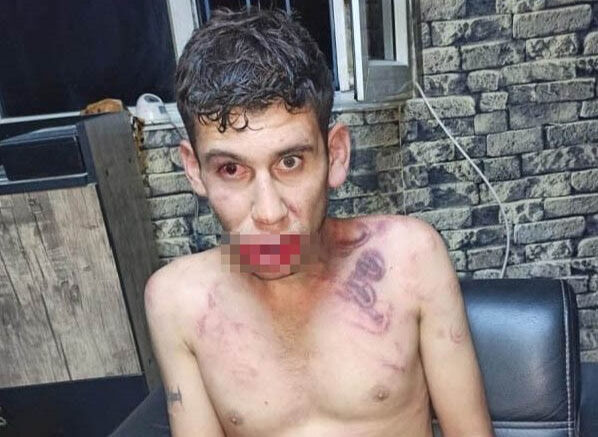 Antalya'ya çalışmak için giden Şanlıurfalı Vedat Kurt'a elektrik verilerek, dişi kırılarak ve böcek yedirilerek işkence yapıldı - 2. Resim