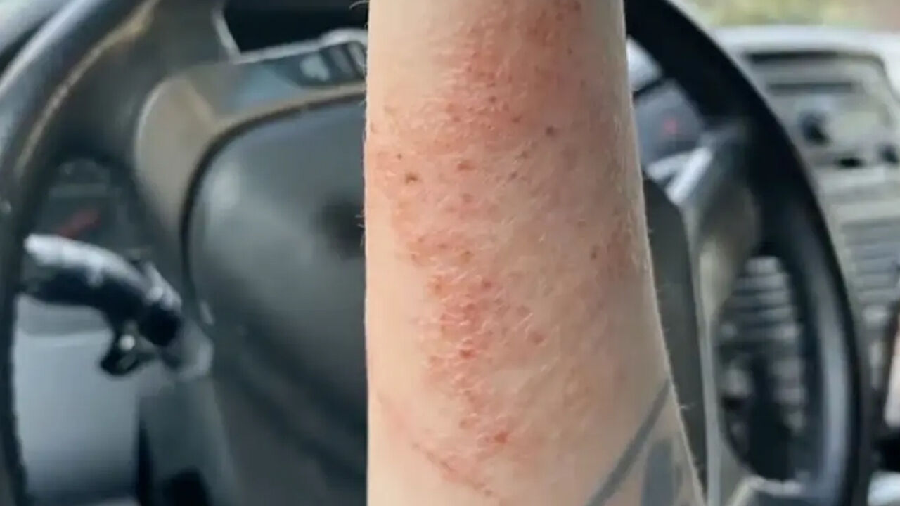 Temizlik yaparken kabusu yaşadı! Örümcek saldırısına uğradı, yüzü yaralarla kaplandı Temizlik yaparken kabusu yaşadı! Örümcek saldırısına uğradı, yüzü yaralarla kaplandı - 2. Resim