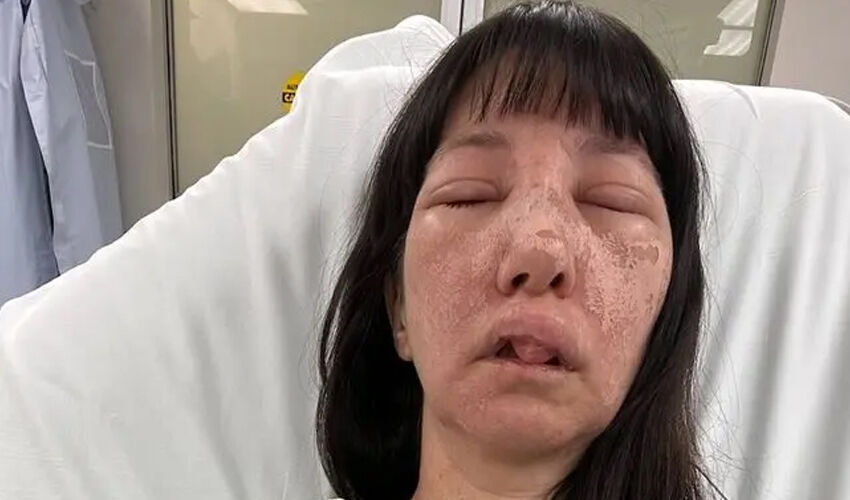 Temizlik yaparken kabusu yaşadı! Örümcek saldırısına uğradı, yüzü yaralarla kaplandı Temizlik yaparken kabusu yaşadı! Örümcek saldırısına uğradı, yüzü yaralarla kaplandı - 3. Resim