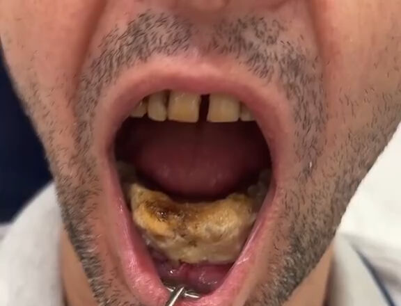 Doktoru hayrete düşüren vaka: Japon yapıştırıcısıyla kendine diş yaptı! Doktoru hayrete düşüren vaka: Japon yapıştırıcısıyla kendine diş yaptı! - 1. Resim