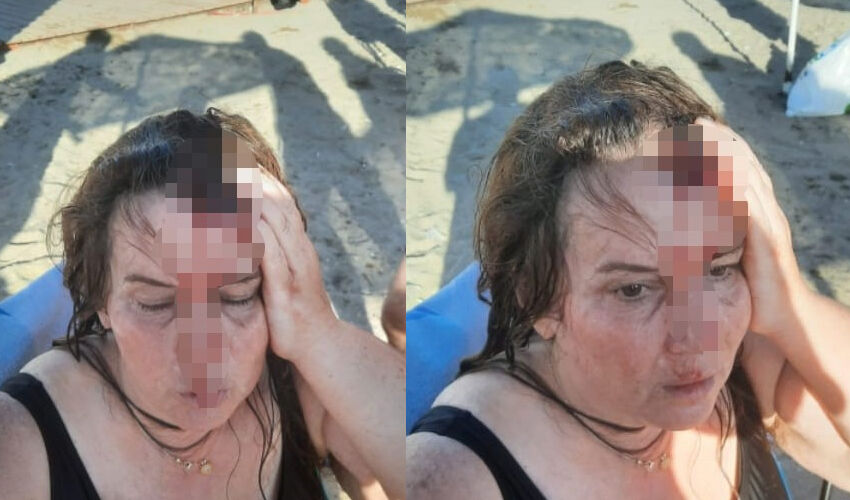 Denizde yüzerken jet ski çarptı! Başına gelenler korkunç: Etrafım kan içindeydi - 1. Resim