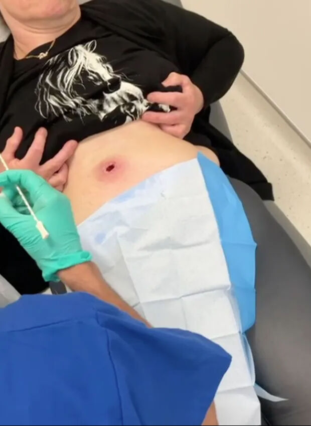 Çamaşır asarken örümcek ısırdı! Karnında kocaman bir delik oluştu - 2. Resim