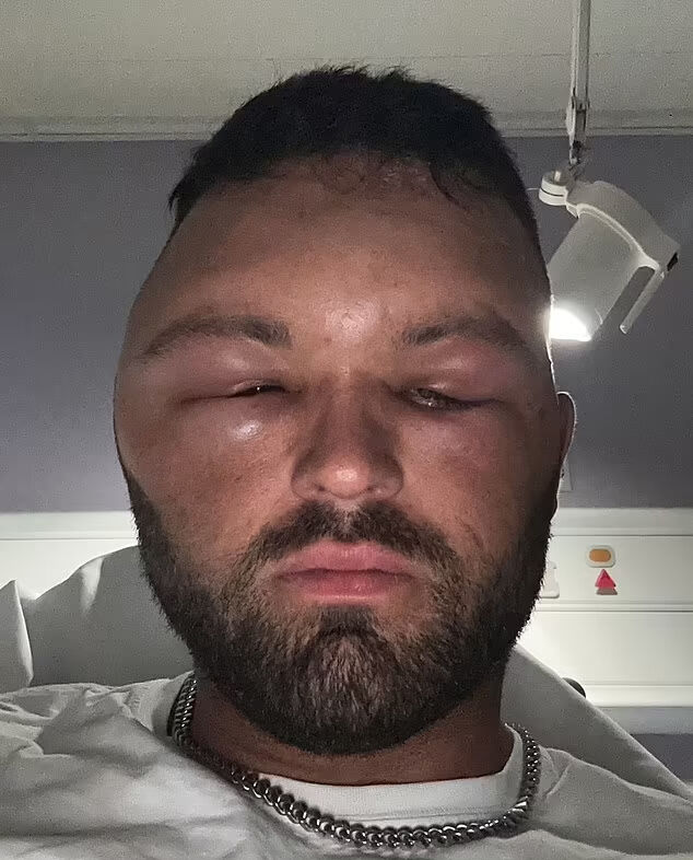 Her şey küçük bir kızarıklıkla başladı, kafası balon gibi şişti! ‘Kız arkadaşım bana bakamıyordu’ - 1. Resim