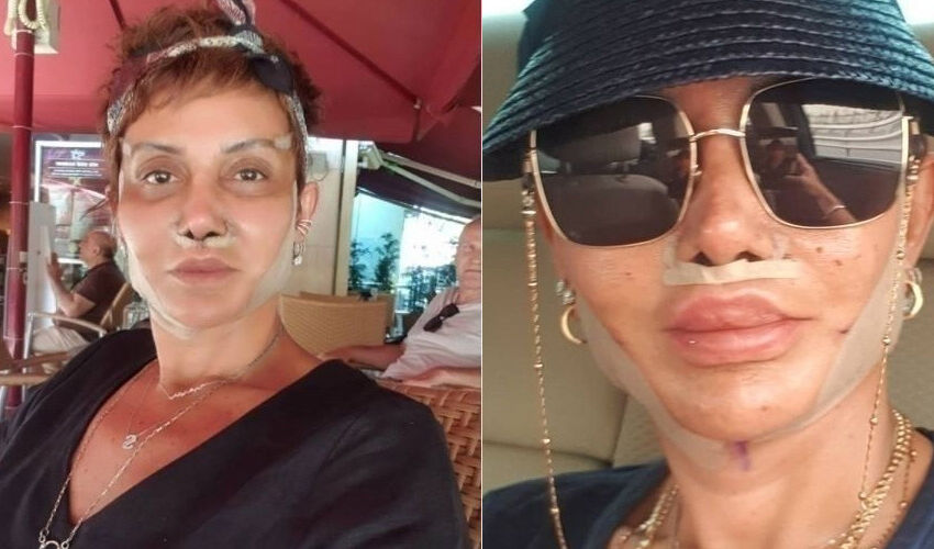 Serap Paköz’den estetik çıkışı: ‘Yaptırmadım’ diyenlere gülüyorum - 1. Resim