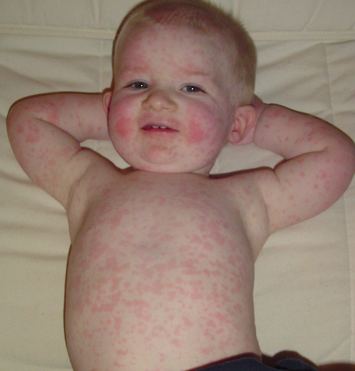 Vakalarda patlama yaşanıyor! ABD'de yeni kâbus parvovirüs B19: 5-9 yaşları arasındaki çocukları vuruyor! Vakalarda patlama yaşanıyor! ABD'de yeni kâbus parvovirüs B19: 5-9 yaşları arasındaki çocukları vuruyor! - 2. Resim