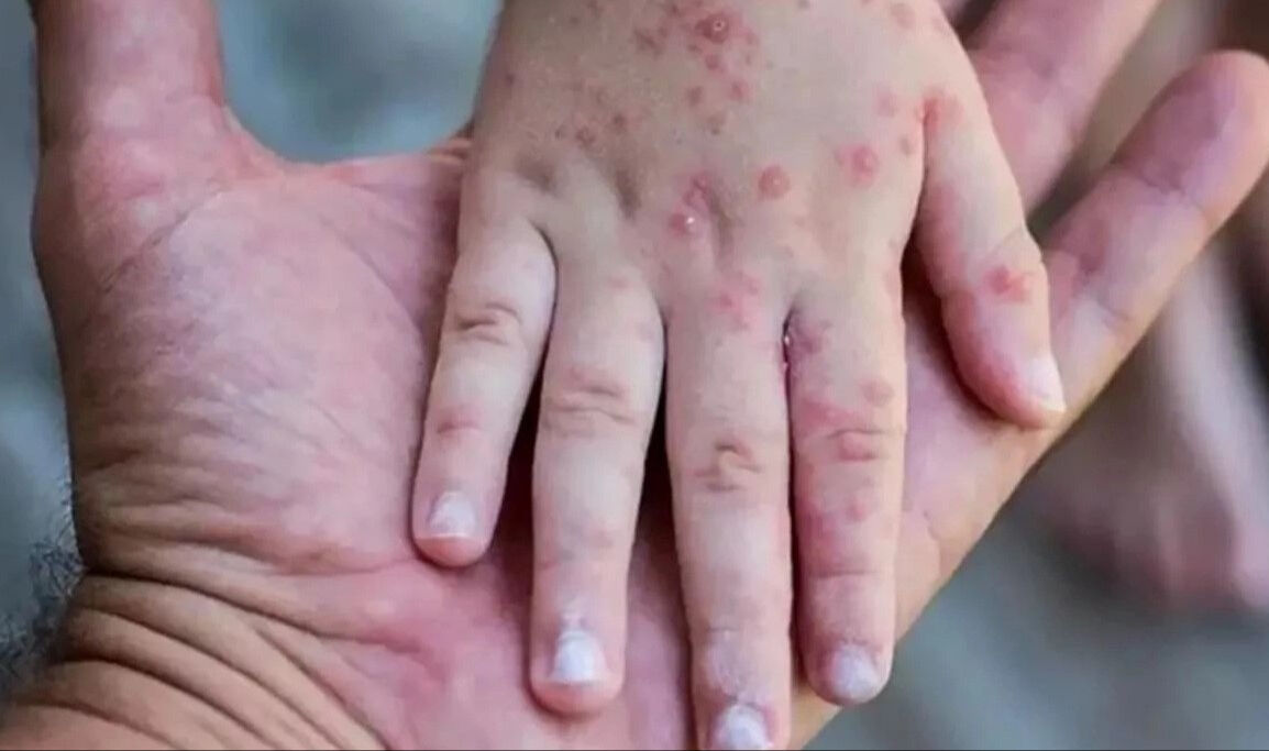 Maymun çiçeği virüsü dünyaya yayılıyor! İsveç'in ardından bir ülkede daha görüldü - 2. Resim