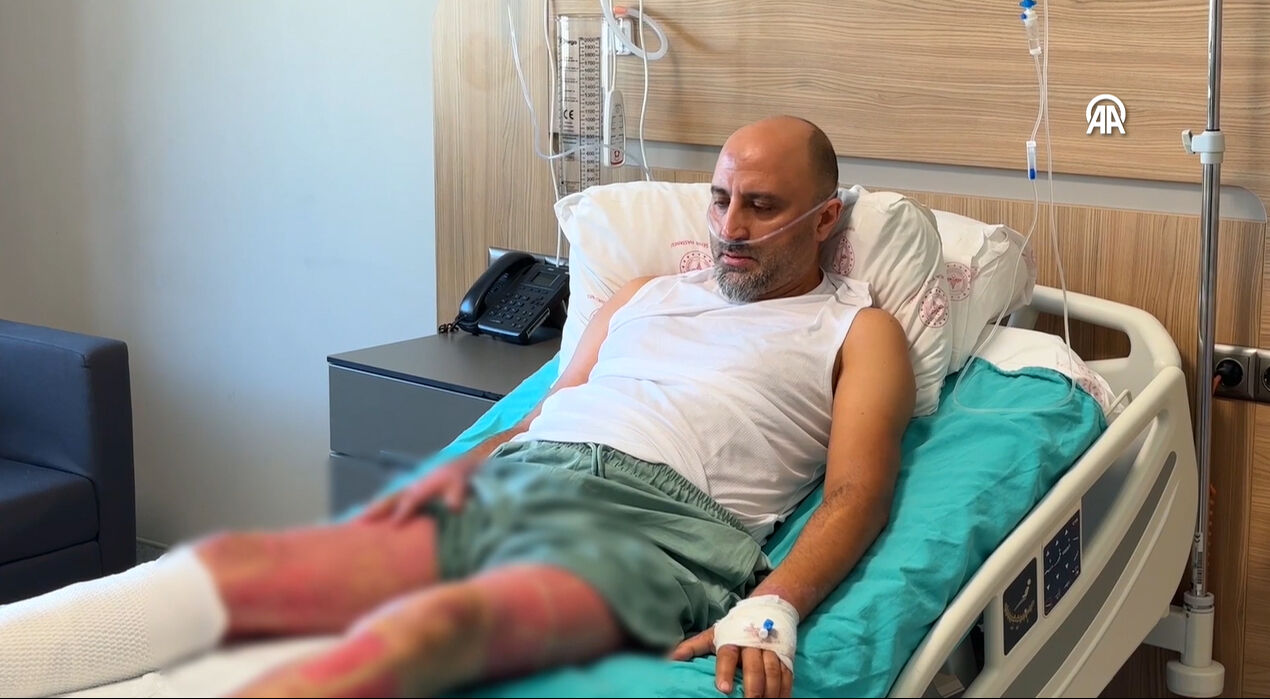 Mangal jeli hayatını kararttı! Vücudunun üçte biri yandı - 2. Resim