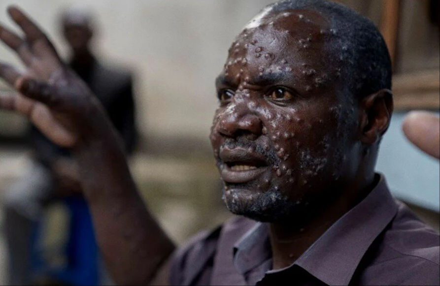 Merak ettiğiniz her şey burada! Sağlık Bakanlığı'ndan maymun çiçeği virüsü rehberi - 7. Resim