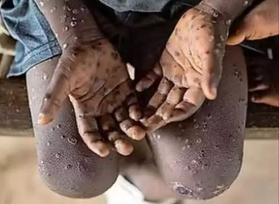 Merak ettiğiniz her şey burada! Sağlık Bakanlığı'ndan maymun çiçeği virüsü rehberi - 8. Resim