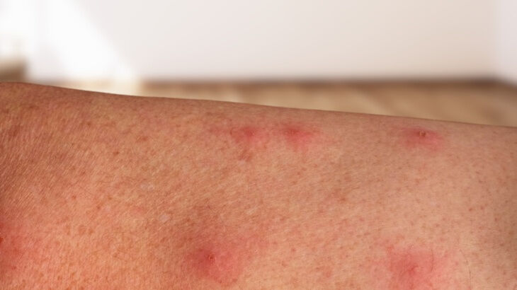 Sağlık Bakanlığı'ndan yeni rehber! Maymun çiçeği virüsü nasıl anlaşılır? Virüs nasıl bulaşır?  İşte detaylar... - 7. Resim