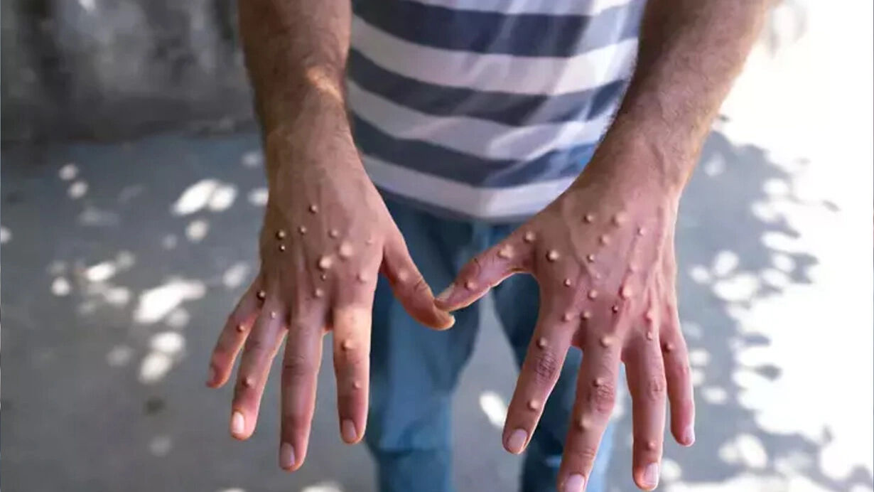 Sağlık Bakanlığı'ndan yeni rehber! Maymun çiçeği virüsü nasıl anlaşılır? Virüs nasıl bulaşır?  İşte detaylar... - 4. Resim