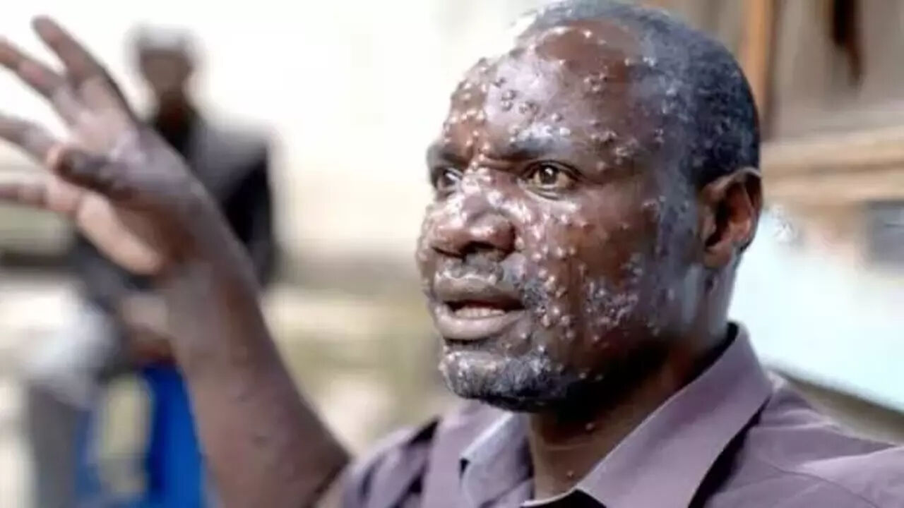 Sağlık Bakanlığı'ndan yeni rehber! Maymun çiçeği virüsü nasıl anlaşılır? Virüs nasıl bulaşır?  İşte detaylar... - 6. Resim