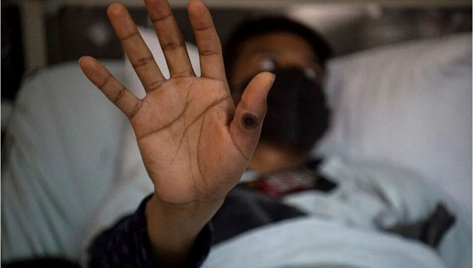 Sağlık Bakanlığı'ndan yeni rehber! Maymun çiçeği virüsü nasıl anlaşılır? Virüs nasıl bulaşır?  İşte detaylar... - 3. Resim