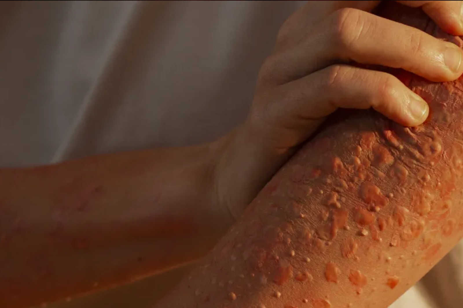 Sağlık Bakanlığı'ndan yeni rehber! Maymun çiçeği virüsü nasıl anlaşılır? Virüs nasıl bulaşır?  İşte detaylar... - 15. Resim