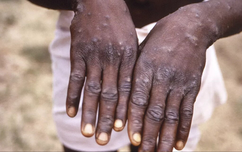 Maymun çiçeği kabusu sürüyor! Bir ülkede daha tespit edildi - 8. Resim