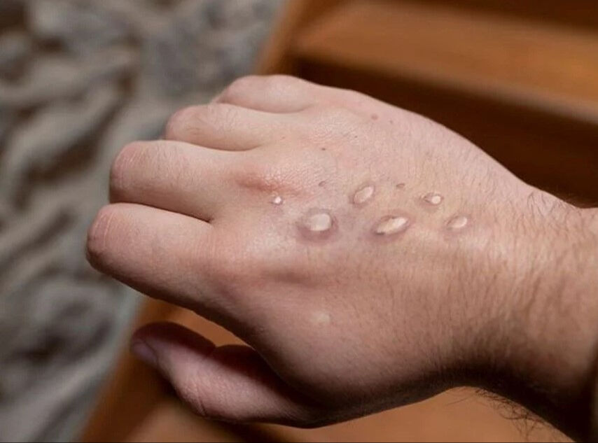 Maymun çiçeği kabusu sürüyor! Bir ülkede daha tespit edildi - 5. Resim