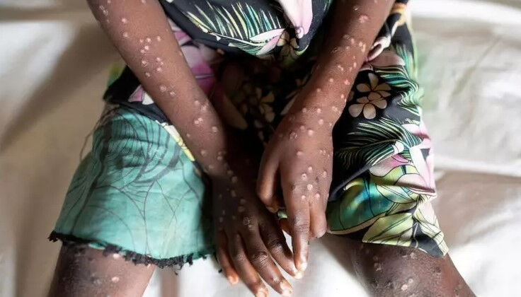 Maymun çiçeği kabusu sürüyor! Bir ülkede daha tespit edildi - 2. Resim