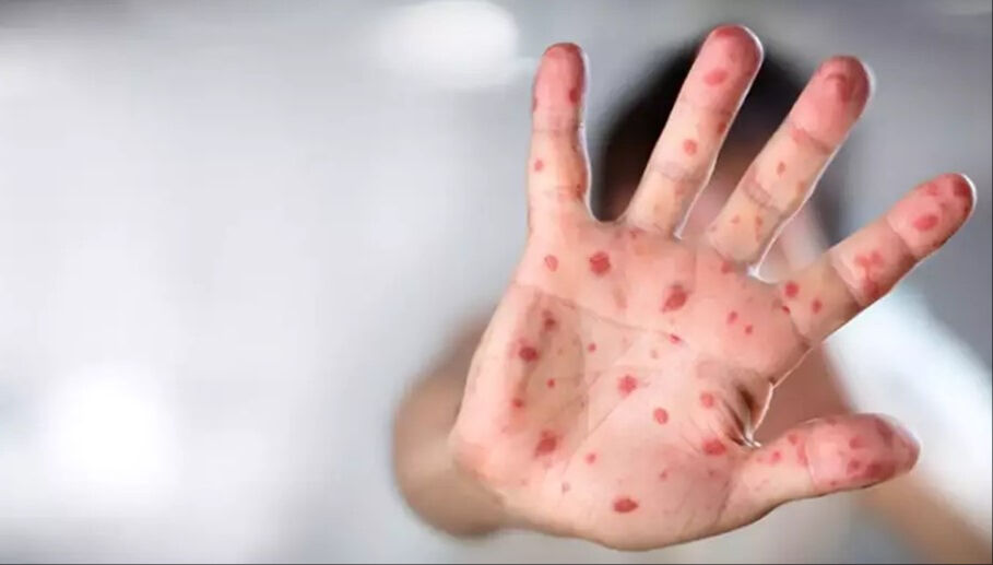 Maymun çiçeği kabusu sürüyor! Bir ülkede daha tespit edildi - 9. Resim