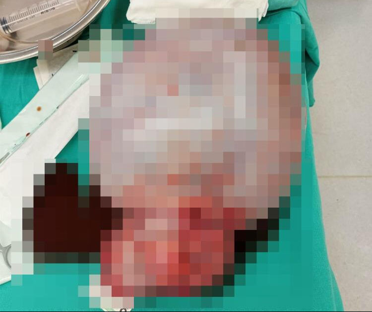 Karın ağrısı ile başvurdu, gerçeği öğrenince şoke oldu! ‘Büyük olacağını beklemiyordum, çok şaşırdım’ - 4. Resim