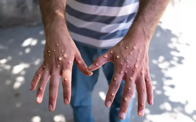 Türkiye'de ilk maymun çiçeği karantinası Ankara'da mı uygulandı? Resmi açıklama geldi - 1. Resim