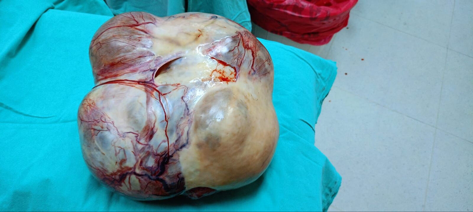 Ağrı, şişlik ve nefes darlığı şikayetiyle hastaneye gitti! Karnından çıkan doktorları bile şaşırttı - 3. Resim