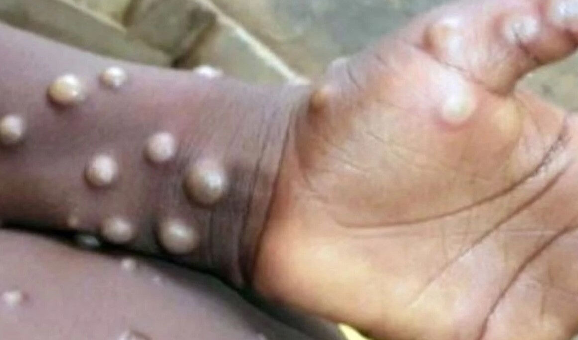 Maymun çiçeği virüsüyle ilgili korkutan açıklama! Ölen kişi sayısını duyurdular Maymun çiçeği virüsüyle ilgili korkutan açıklama! Ölen kişi sayısını duyurdular - 3. Resim