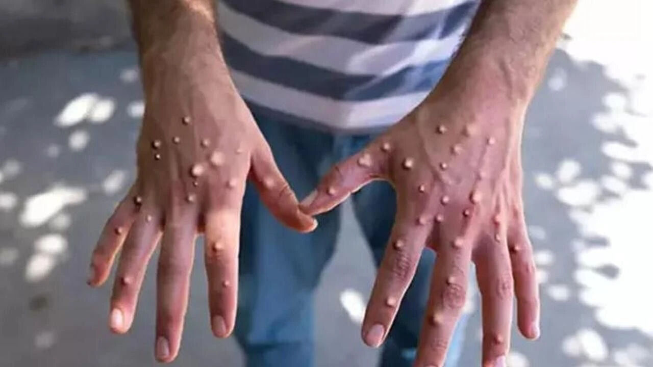 Maymun çiçeği virüsüyle ilgili korkutan açıklama! Ölen kişi sayısını duyurdular Maymun çiçeği virüsüyle ilgili korkutan açıklama! Ölen kişi sayısını duyurdular - 1. Resim