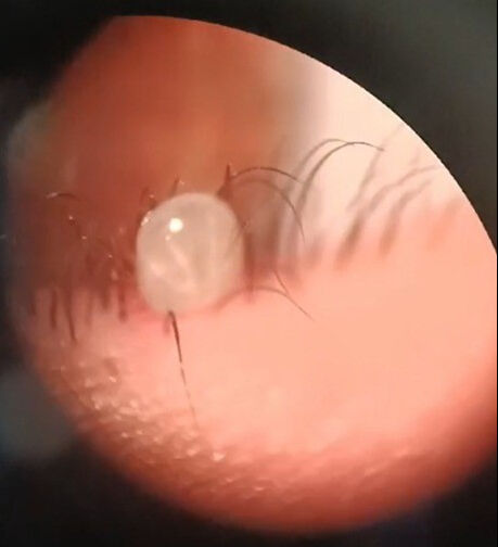 Bitlis'te kedi seven kızın gözüne kene kaçtı Bitlis'te kedi seven kızın gözüne kene kaçtı - 1. Resim