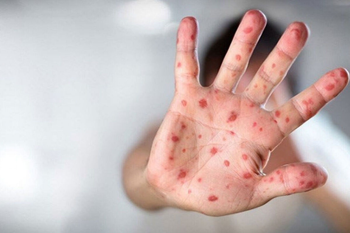 'Acil durum' ilan edilmişti! Nijerya'da M çiçeği vaka sayısı 48'e yükseldi 'Acil durum' ilan edilmişti! Nijerya'da M çiçeği vaka sayısı 48'e yükseldi - 1. Resim