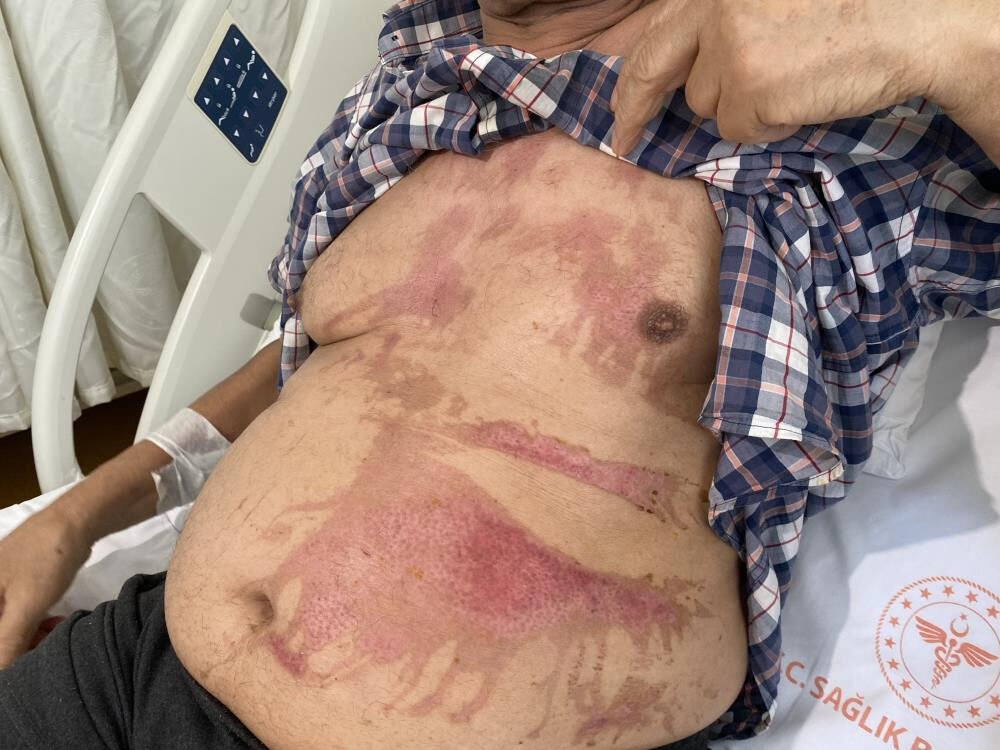 Bahçelievler'de tıkanan gideri açmak isterken vücudunun yüzde 40'ı yandı - 4. Resim