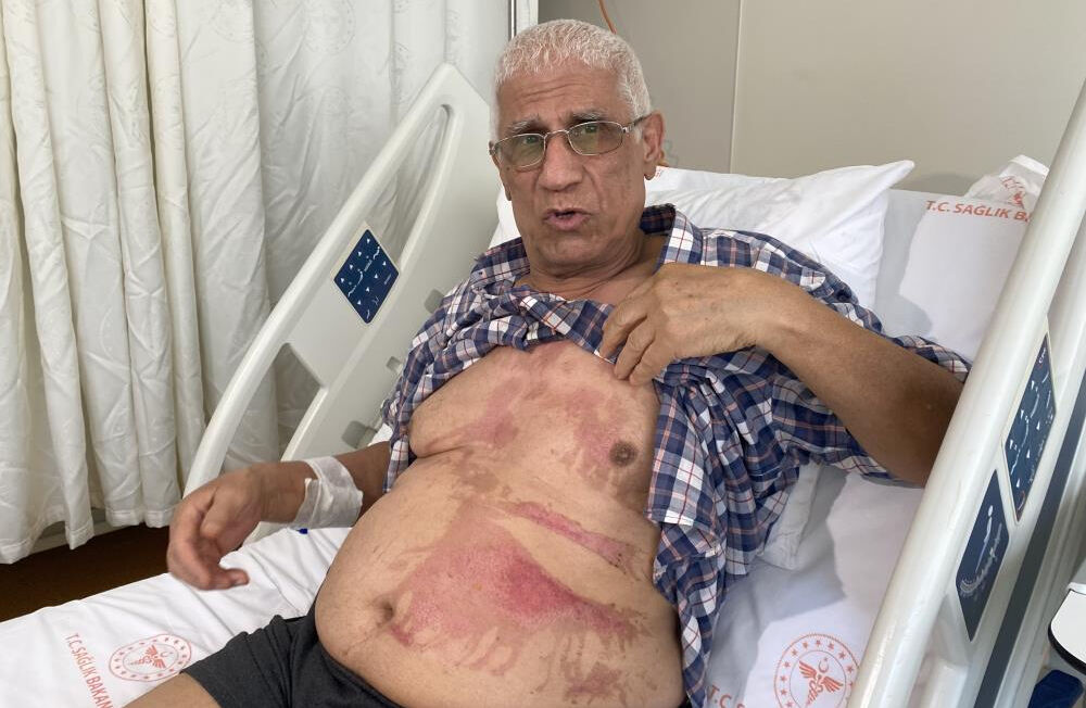 Bahçelievler'de tıkanan gideri açmak isterken vücudunun yüzde 40'ı yandı - 3. Resim