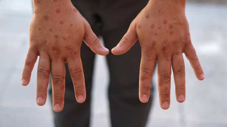 Dünyayı kasıp kavuran Maymun Çiçeği Fas'ta da görüldü - 1. Resim