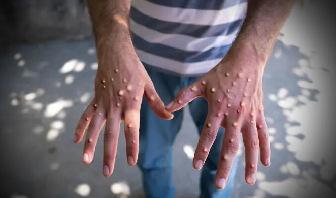 Dünyayı kasıp kavuran Maymun Çiçeği Fas'ta da görüldü - 4. Resim