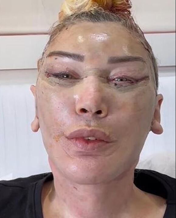 Estetik nedeniyle yüzü deforme olmuştu! Seda Sayan’ın ablası Nursel Sayan’ın son hali ortaya çıktı - 2. Resim