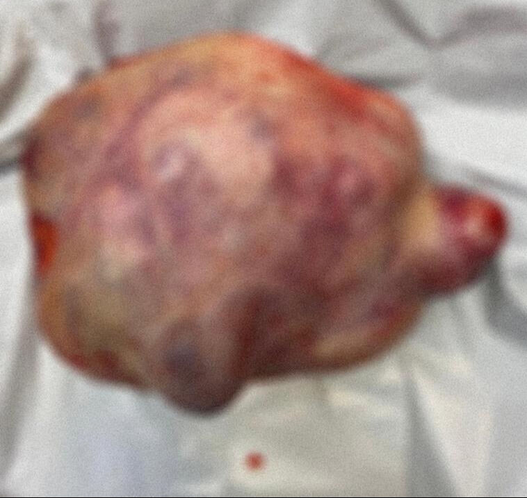 Korktuğu için doktora gitmedi, tümör bir anda büyüdü! “Hayatım bitiyor, ölüyorum dedim” - 1. Resim