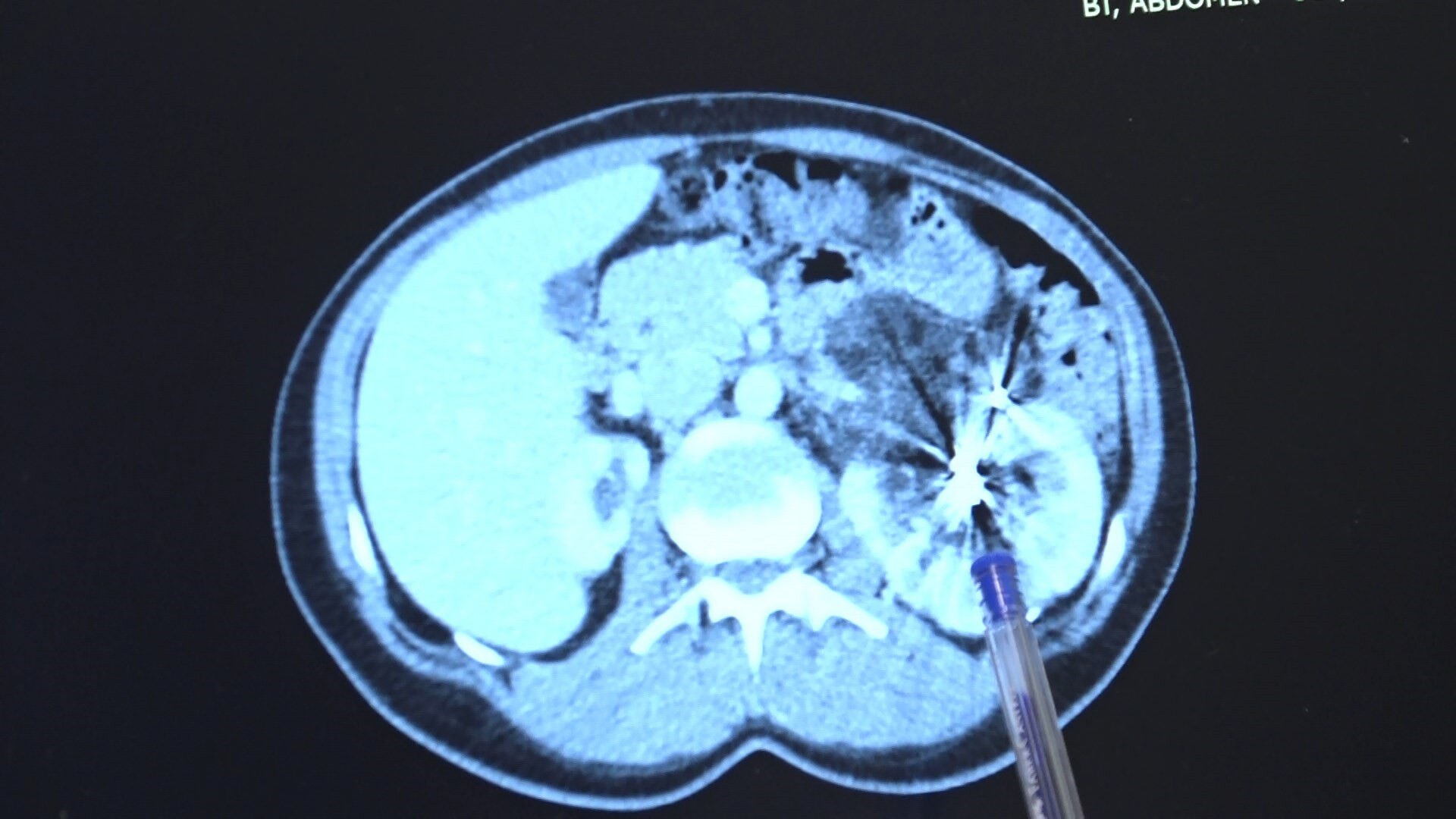 Fıtık için gitti, hayatının şokunu yaşadı! 35 yaşında tek böbrekli olduğunu öğrenen kadın son anda kurtuldu - 1. Resim