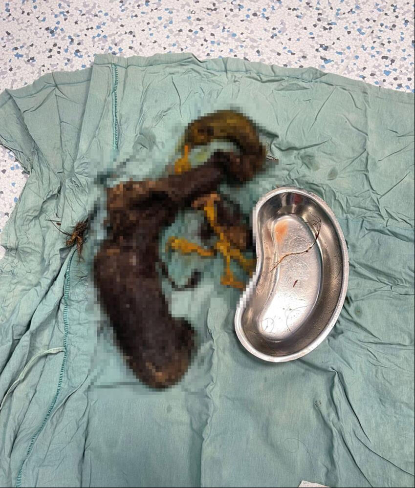 Adet görememe şikayetiyle gitti, midesinden 3 buçuk kilo saç kılı çıktı - 2. Resim