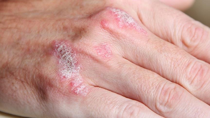 Kış aylarında cildinizi soğuktan koruyun - 1. Resim