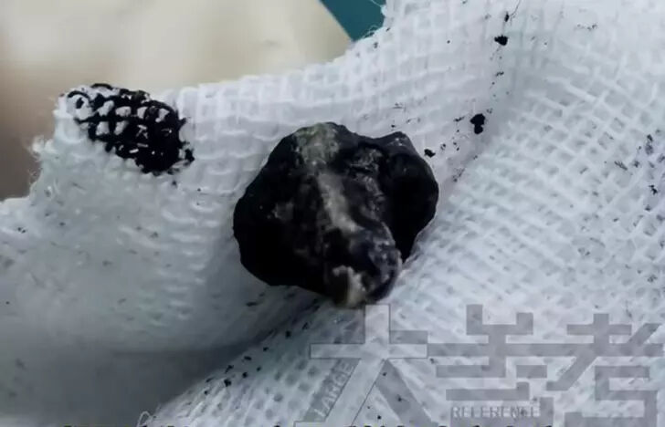 Yıllarca kötü koku şikayeti çekiyordu: Küçük çocuğun burnundaki cisim şoke etti - 2. Resim