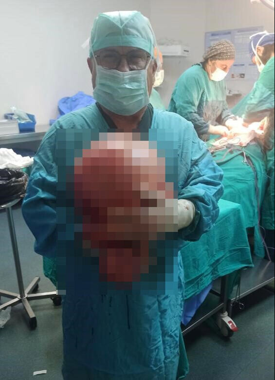 Karnı hamile gibi şişti, gerçek hastaneye gidince ortaya çıktı! 47 yıllık doktorun hayatında bir ilk Karnı hamile gibi şişti, gerçek doktora gidince ortaya çıktı! 47 yıllık doktorun hayatında bir ilk - 6. Resim