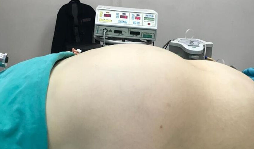 Karnı hamile gibi şişti, gerçek hastaneye gidince ortaya çıktı! 47 yıllık doktorun hayatında bir ilk Karnı hamile gibi şişti, gerçek doktora gidince ortaya çıktı! 47 yıllık doktorun hayatında bir ilk - 5. Resim