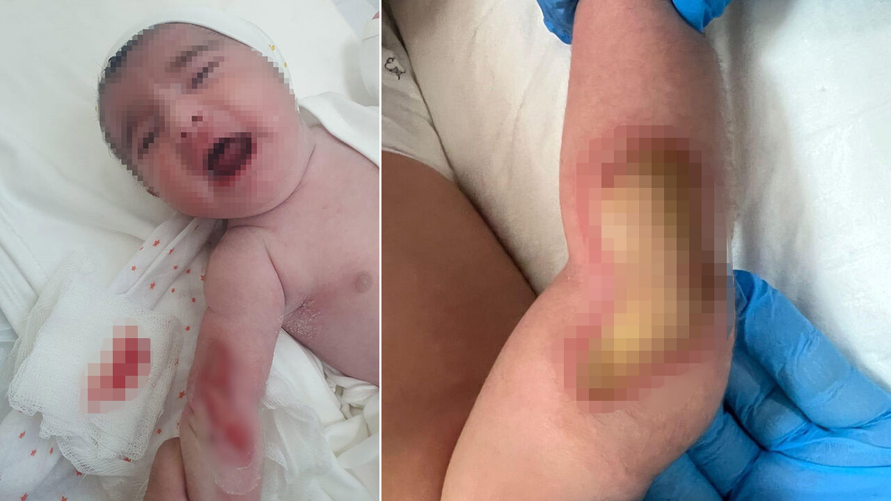 5 günlük bebeğin kolu feci şekilde yandı! Ailenin iddiaları kan dondurdu - 1. Resim