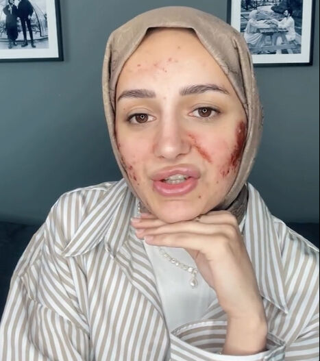 ‘Amin’ videosuyla tanınan Gizem Yıldız tanınmaz halde! Başına gelenleri tek tek anlattı ‘Amin’ videosuyla tanınan Gizem Yıldız tanınmaz halde! Başına gelenleri tek tek anlattı - 3. Resim