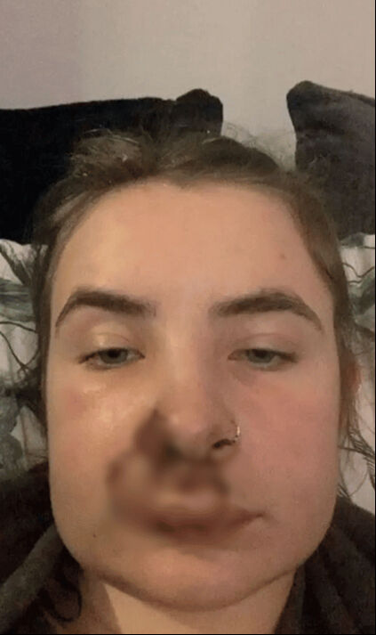 Otobüste korkunç saldırı! Genç kızın yüzünü ısırdı, 50 dikiş atıldı 19 yaşındaki genç kız otobüste saldırıya uğradı, ''Çığlık bile atamadım'' - 1. Resim