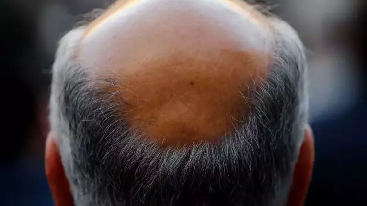 İngiltere'de emsal karar: Erkeğe kel demek cinsel taciz! - 1. Resim