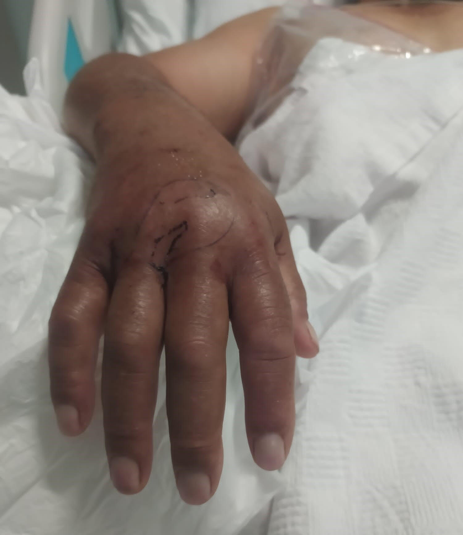 'Sanki mermi sıkılmış gibiydi'! Hatay'da engerek yılanının ısırdığı çiftçi hayata tutunmayı başardı - 1. Resim