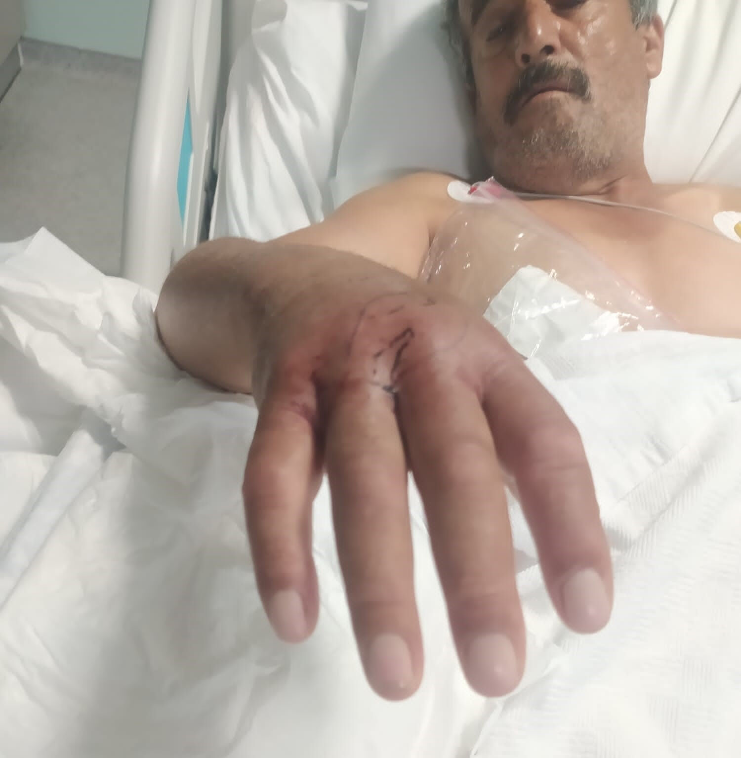 'Sanki mermi sıkılmış gibiydi'! Hatay'da engerek yılanının ısırdığı çiftçi hayata tutunmayı başardı - 4. Resim