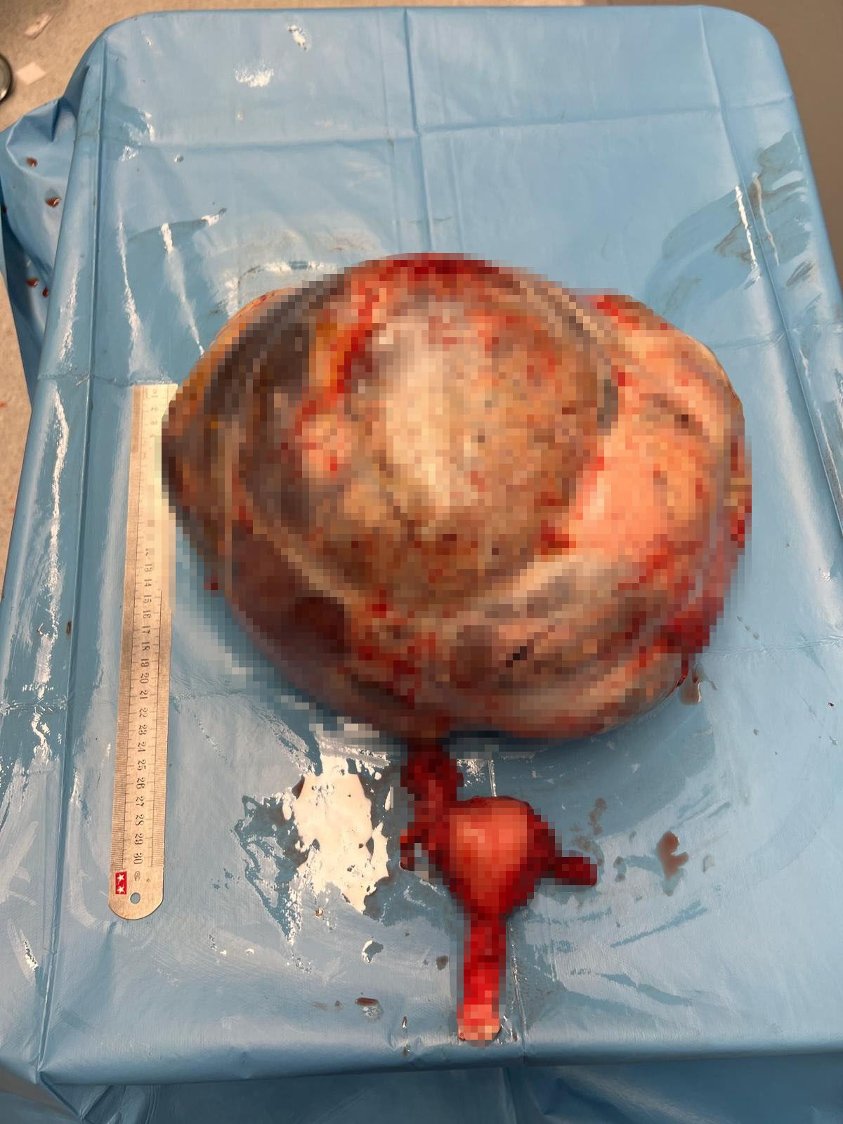 Doktorlar bile şaşkına uğradı! Fark edilmeyen tümör 30 santimetre büyüdü Doktorları bile şaşkına uğrattı! Fark edilmeyen tümör 30 santimetre büyüdü - 1. Resim