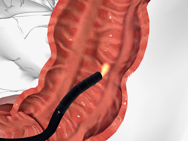 Kolonoskopi nasıl yapılır? - 3. Resim